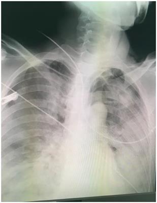 Extracorporeal Membrane Oxygenation for Acute Toxic Inhalations: Case Reports and Literature Review